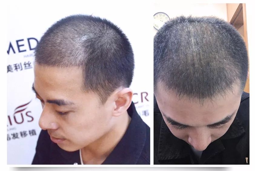 左→右:植发30天,50天效果展示