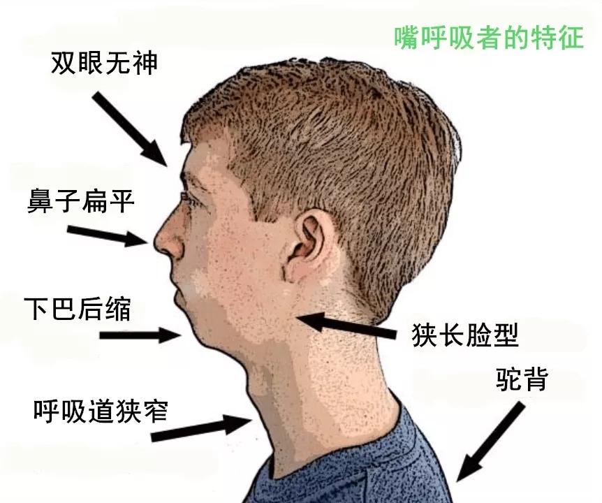 迟钝,智商减低 长残了 上唇短厚翘起,牙龈因为长期开口干燥而色素沉着