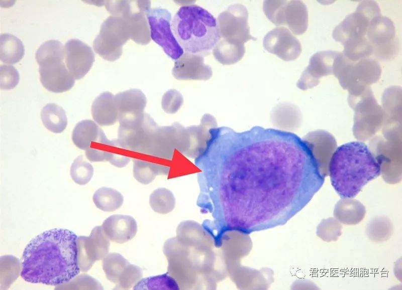 巨原始红细胞多分叶核巨核细胞骨髓涂片颗粒增多中性杆状核粒细胞大红