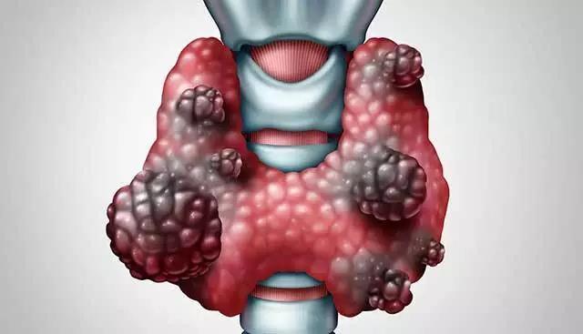 乐康肿瘤专家:如何通过超声检查判断甲状腺结节的良恶性