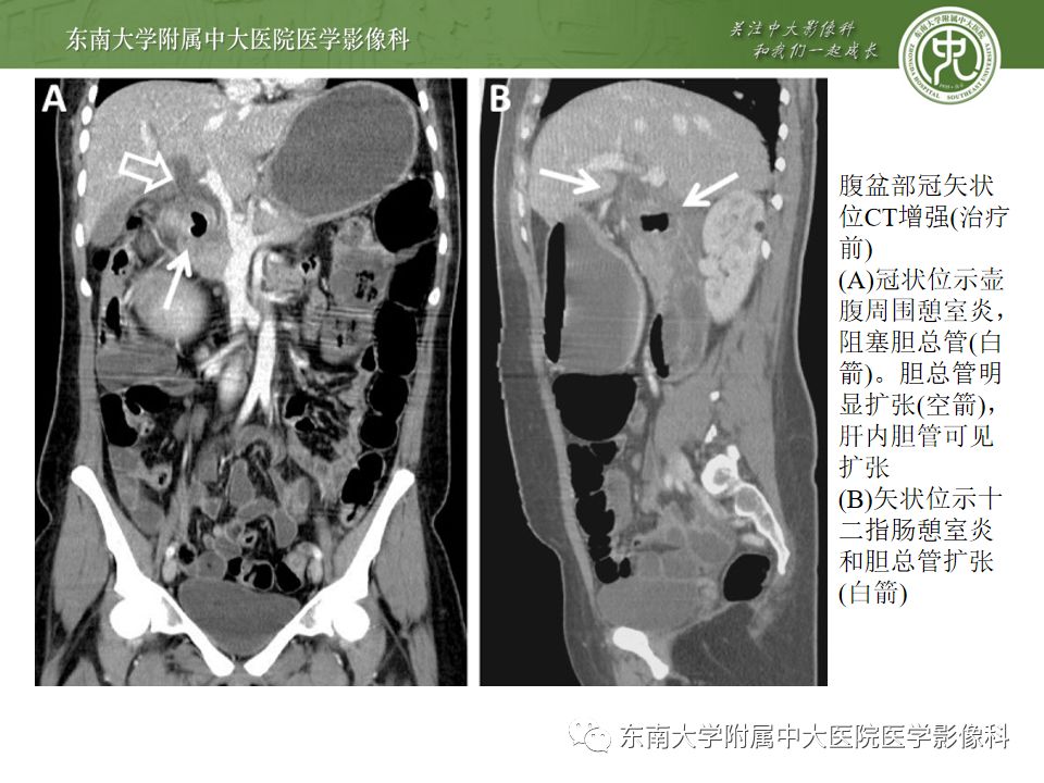 十二指肠憩室ct图片,结肠憩室图片,小肠憩室图片