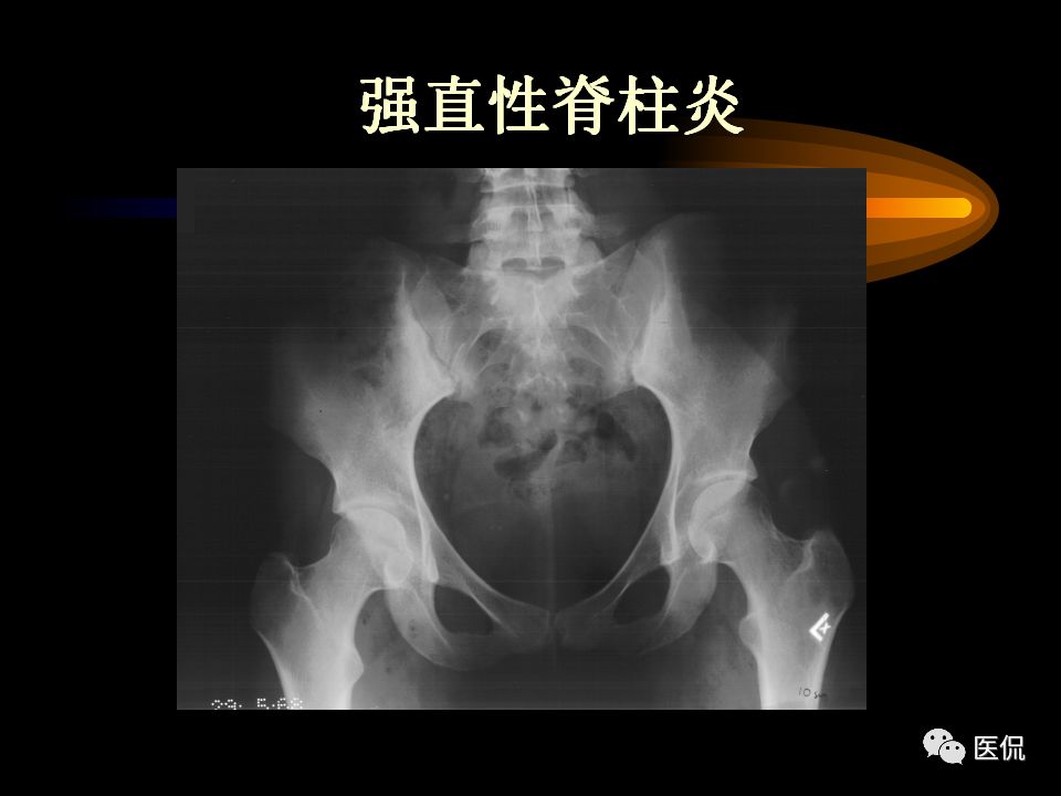 类风湿关节炎强直性脊柱炎影像学诊断