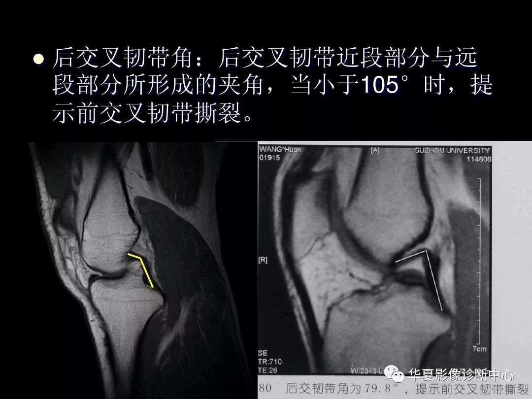 最全的膝关节解剖及mri诊断二