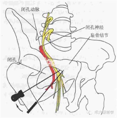 闭孔神经解剖/易卡压点/触诊/牵张治疗