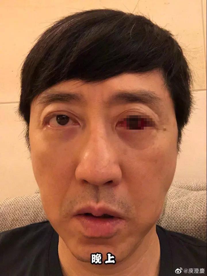 庾澄庆“血眼”吓懵网友 医生却说这病很常见