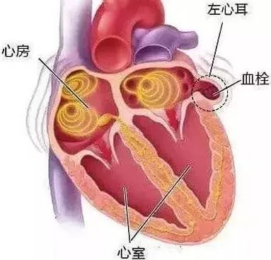 房颤患者中风和左心耳有什么关系?