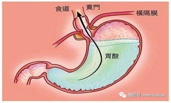 从怀孕的第2个月开始,孕妇血液中孕激素水平逐步增高,导致孕妇胃贲门