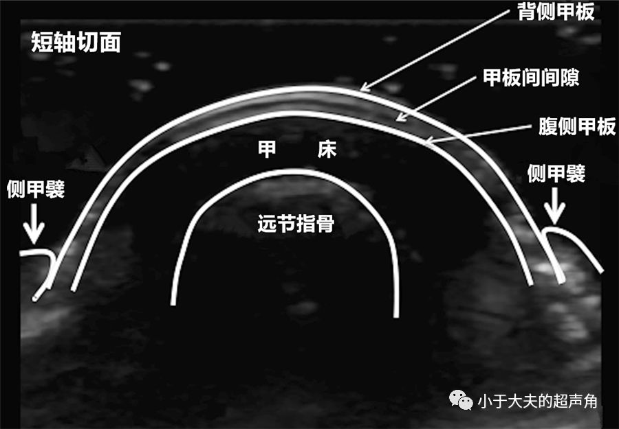 其深方的甲床则属于真皮层,而包围指甲的皮肤皱襞称为甲襞,根据位置分