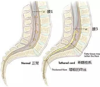 脊髓拴系综合征,什么情况就要立即手术了?