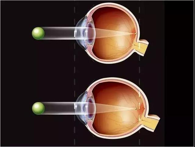手术治疗近视是什么原理_近视激光手术原理图解(2)