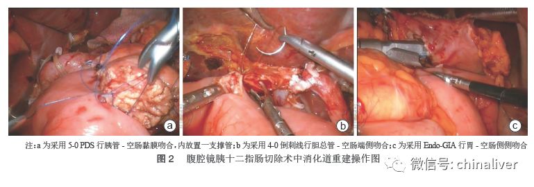 正中开一6～8 cm直切口,先从此处取出标本,再利用此切口完成胰肠吻合