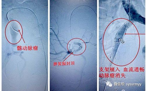 患者 ,任xx ,男,62岁诊断:双侧股浅动脉支架植入术后支架内闭塞术式