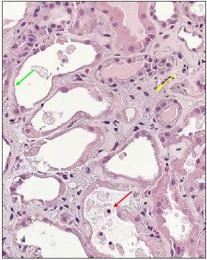 黄色箭头 肾间质水肿明显并伴有炎症细胞浸润图 8 透射电镜:ep:脏层