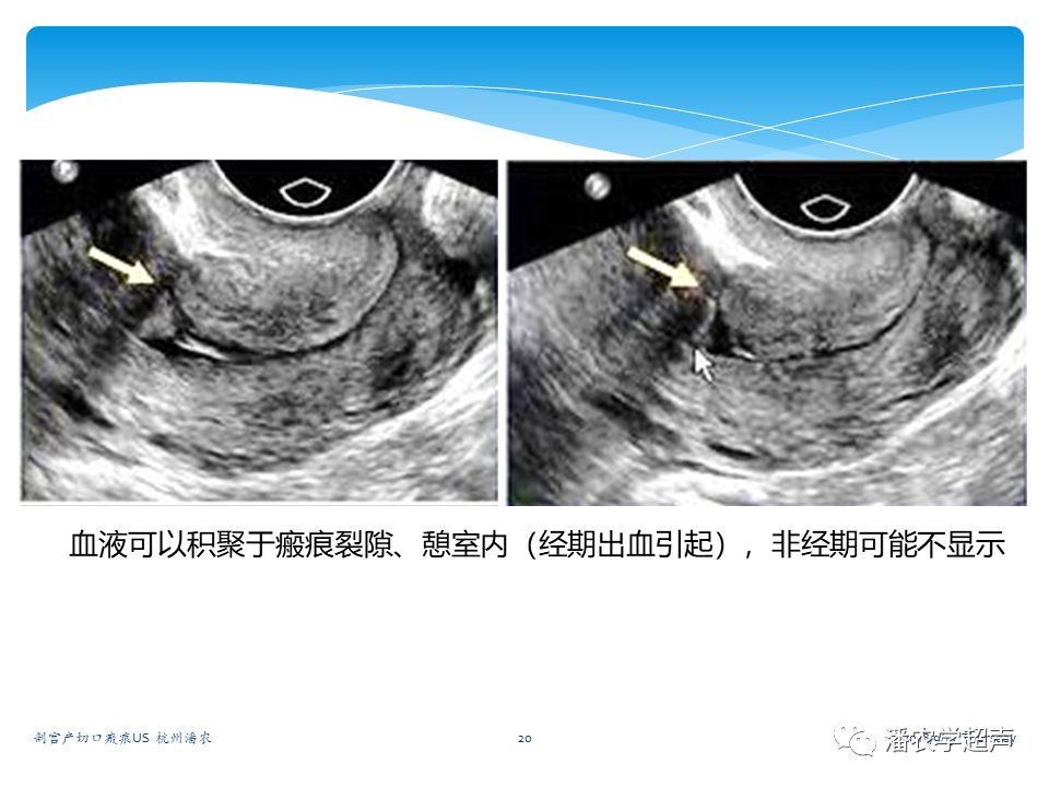 剖宫产子宫切口瘢痕的超声诊断