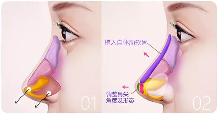 魏红军:肋软骨隆鼻对身体有影响吗?