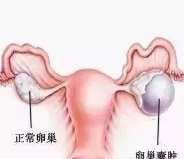 卵巢囊肿,女性从20岁开始就要小心!