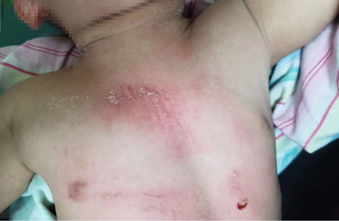                     温州1岁男童被开水烫伤，父母竟往伤口撒盐！原因是…