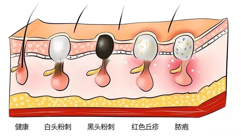 终极黑头清理攻略草莓鼻必看