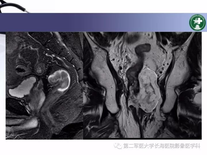 直肠癌mri评价及影像学结构化规范报告