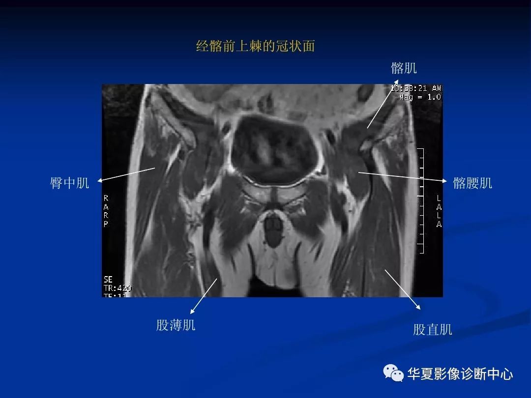 【影像基础】骨盆肌肉的mri解剖图