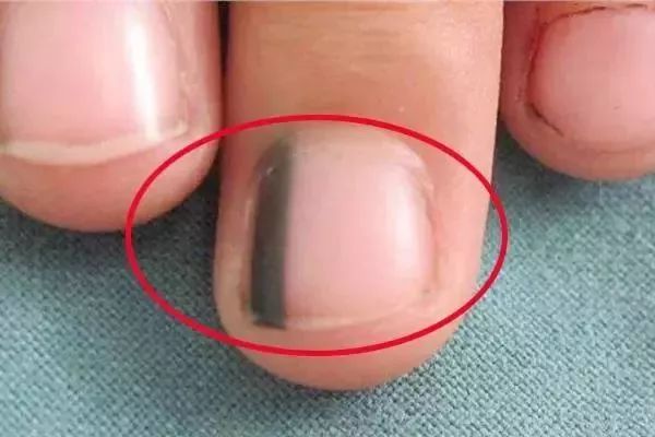 其指甲沿着甲黑线开裂,指甲的两端出现色素沉着,这就是恶变成黑色素瘤