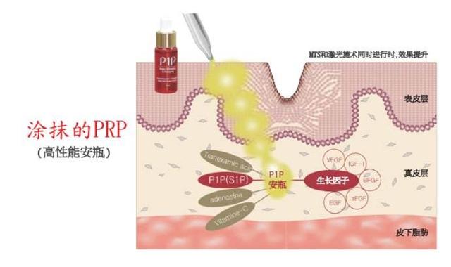 prp治疗糖尿病足