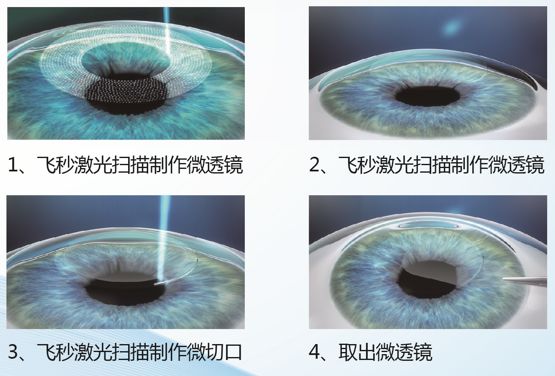 全飞秒近视手术的原理_全飞秒(2)