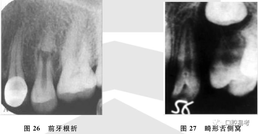 【免费领取】常见牙片—x线片的判读_上颌