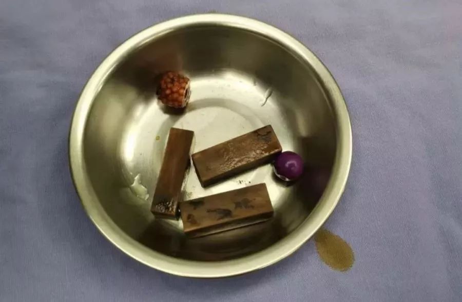                     女童身体发出阵阵臭味，一查下体竟塞入这么多异物…
