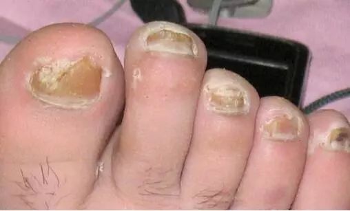 脚趾甲黑黑的,还变厚很难看?一个土方子,药到病除,管用