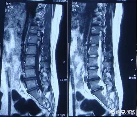 长圆针治疗腰椎间盘突出是什么原理(3)