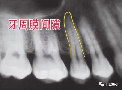 根尖周脓肿:根尖周肉芽肿:根尖周囊肿:根尖周致密性骨炎:牙周炎牙片