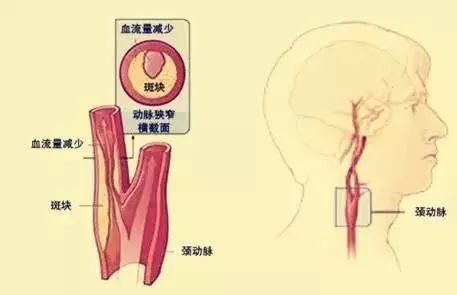 首选的检查方法,可准确诊断胸腔外及颅外段颈动脉的病变部位及程度,术