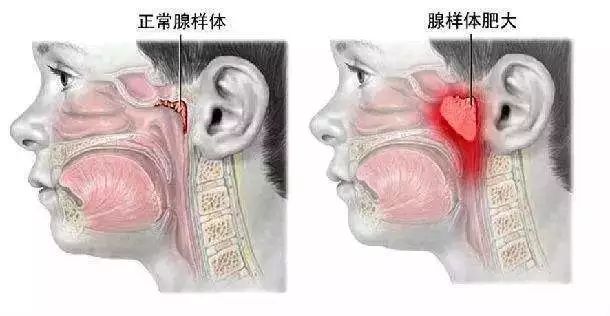 付勇:  长时间的睡觉打呼噜,张口呼吸,会导致夜间 睡眠缺氧,进而