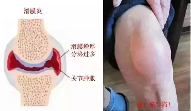 红→肿→热→痛 ○ 红:膝关节处血红血色,清晰可见,一般是在膝盖受伤