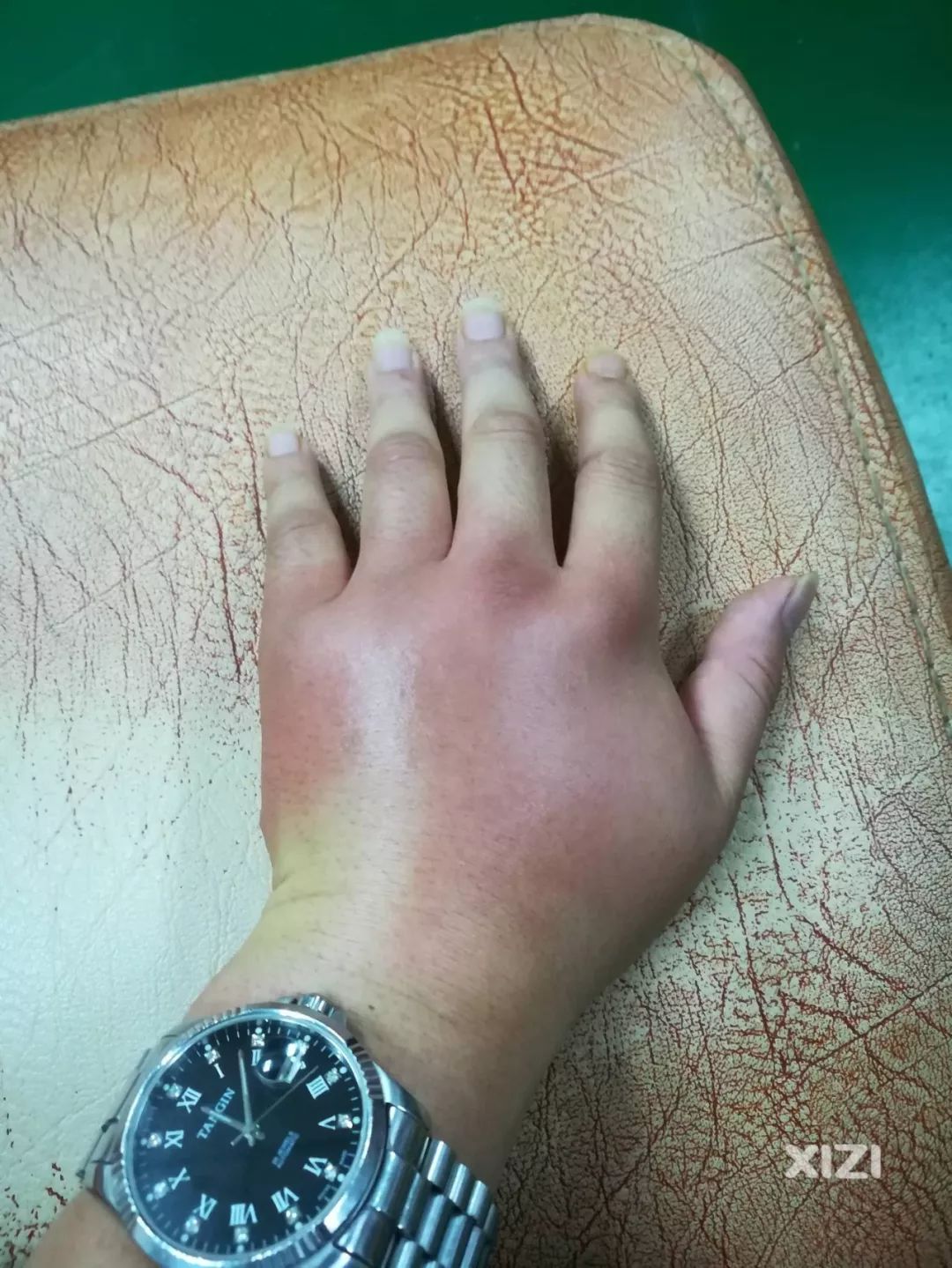 !惠州一网友被小蚂蚁咬了,结果整只手肿成