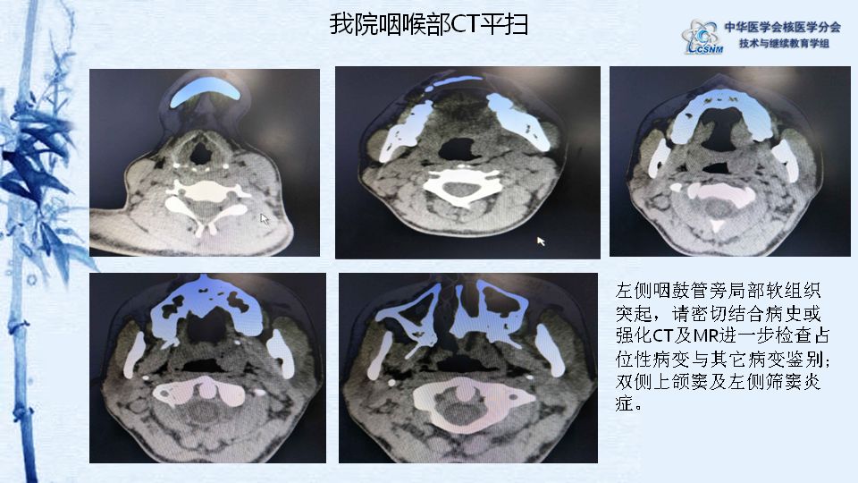 【病例】42期:梅丽努尔 18f-fdg pet-ct诊断咽淋巴环炎症