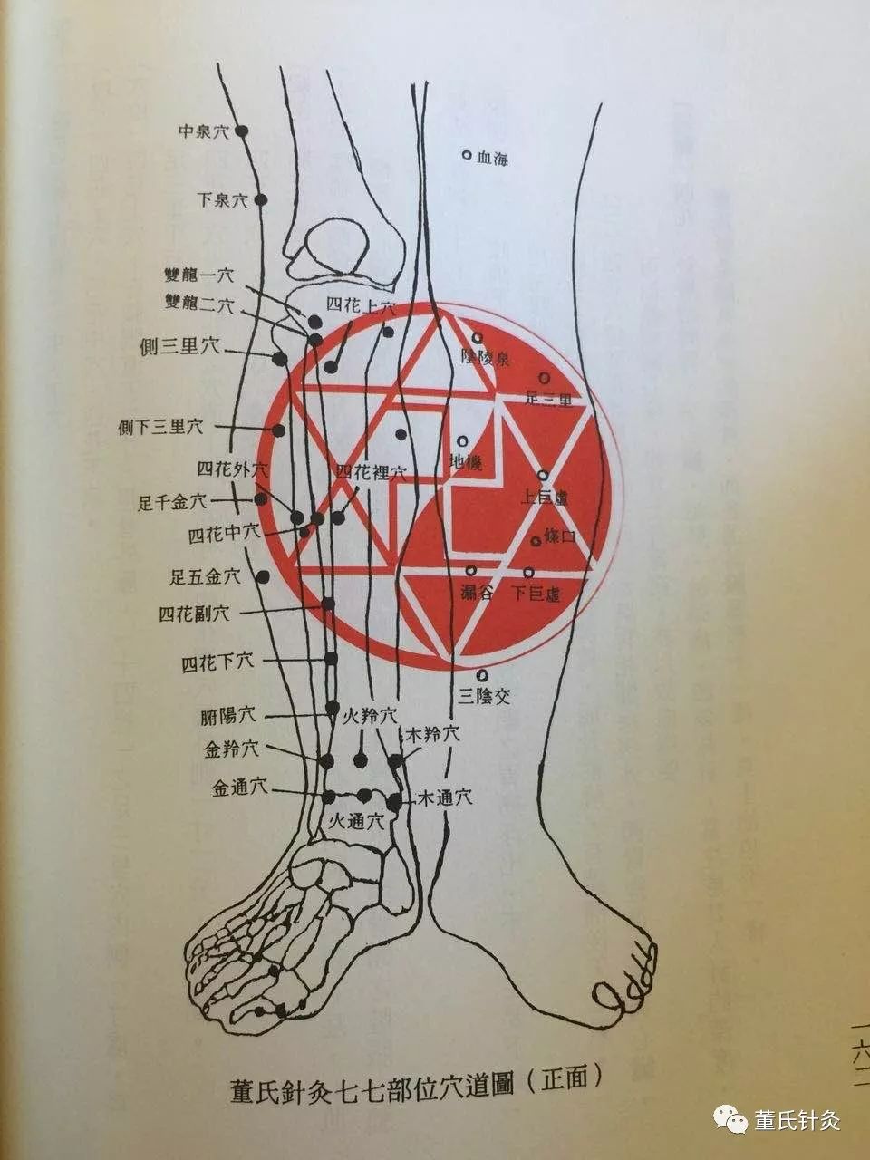 董氏针灸林正泰案例分享之【侧三里,侧下三里穴】