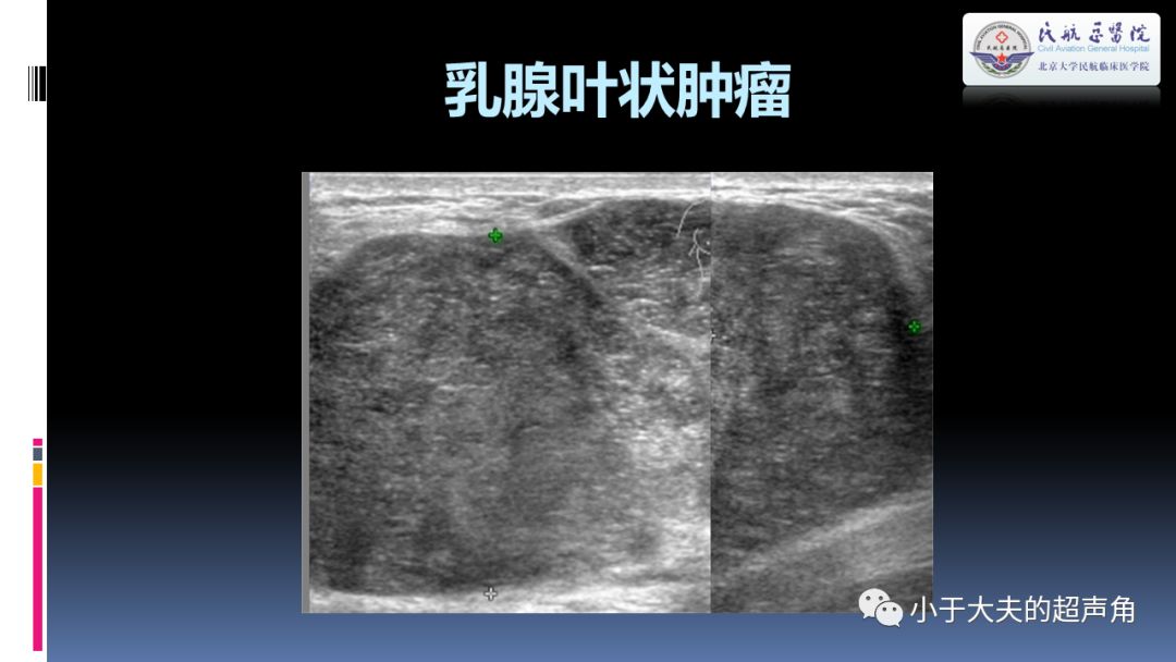 【超声】乳腺疾病欣赏_导管