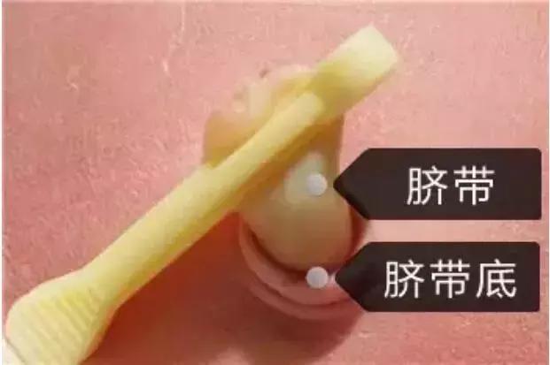                     拿把剪刀就可以剪脐带？宝宝4天感染破伤风命悬一线