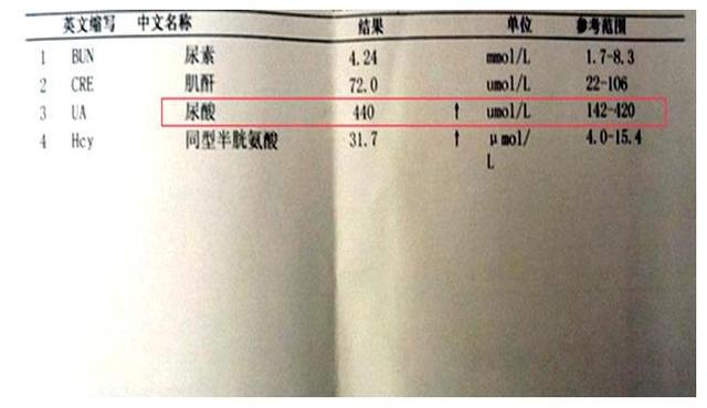 什么时候检查尿酸 89429ac65b704b739c18d9622412fec2.jpeg