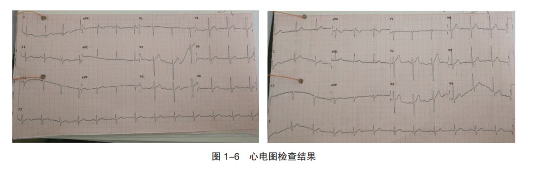 青年血压高怎么办