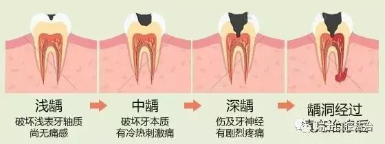 什么是杀牙神经