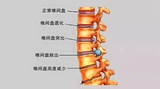 2,腰椎间盘突出发生在椎间盘内,当纤维环破裂后,会压迫脊髓或神经根
