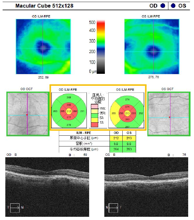 双眼黄斑厚度分析macular cube(黄斑立方扫描)~~现在让我们来看看