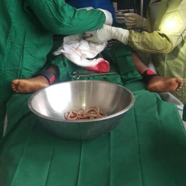 原创非洲4岁男孩腹痛医生动手术从腹中取出数十条蛔虫多到要用盆装