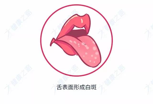 乳白色舌头 口腔黏膜角化