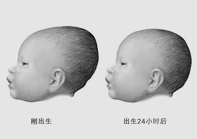                     宝宝的囟门，反映宝宝发育状况，若出现这3种情况，别忽视