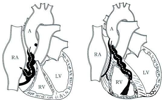 冠状动脉瘘:指左右冠状动脉与心脏或大血管存在先天性异常交通,多为
