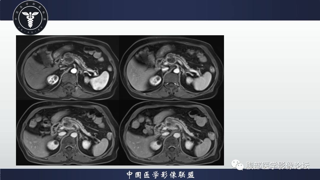 沟槽状胰腺炎影像表现